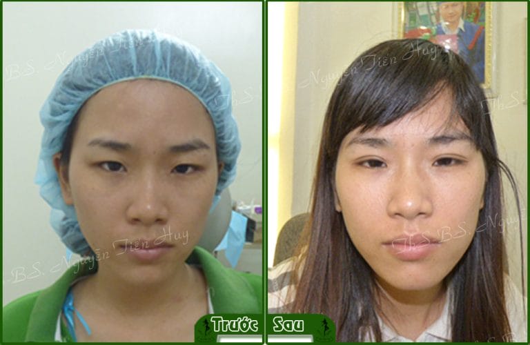 Trước và sau khi tạo mắt hai mí tại Sài Gòn Venus