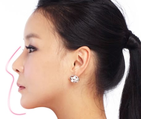 Nâng mũi có cần gây mê hay gây tê gì không?