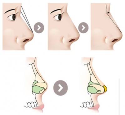 Nâng mũi bị chảy dịch ở mũi có làm sao không?