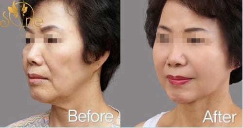 Chùm hình ảnh trước và sau khi căng da mặt tại Sài Gòn Venus