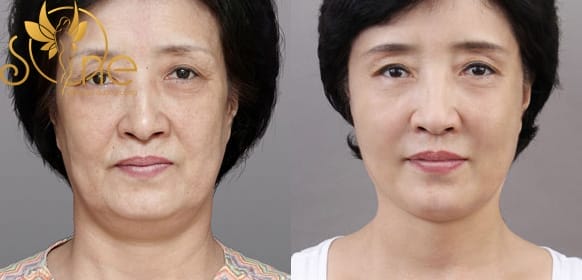 Chùm hình ảnh trước và sau khi căng da mặt tại Sài Gòn Venus